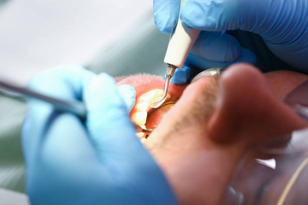 Best Chipped Tooth Repair Near Me  in USA